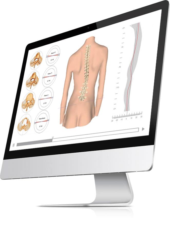 An image of a computer screen displaying a mannequin's spine undergoing a scoliosis scan. | FCE Scan